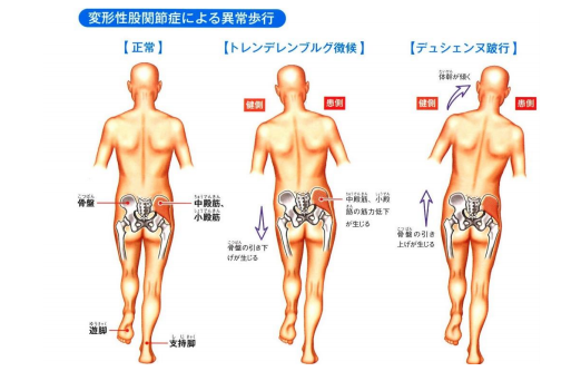 動画あり 歩き方は大丈夫 横揺れの変な歩き方になっていませんか 中臀筋の筋力不足かも Npo法人いきいき のびのび健康づくり協会